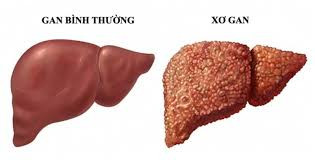 Cấu trúc của gan bình thường và gan xơ - Ảnh minh họa
