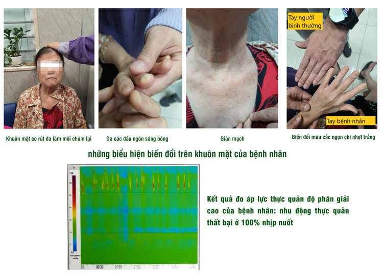 Lầm tưởng khó nuốt do trào ngược, không ngờ bệnh nguy hiểm ảnh 1