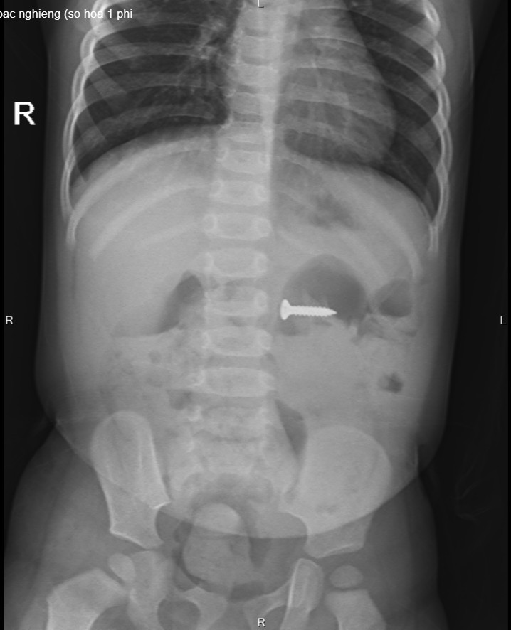 Trẻ 2 tuổi nhuốt đinh sắc nhọn vào bụng mà không ai biết ảnh 1