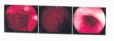 Hình ảnh hạ họng – thực quản của người bệnh sau khi được điều trị