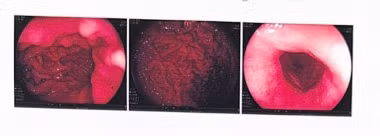 Hình ảnh hạ họng – thực quản của người bệnh sau khi được điều trị