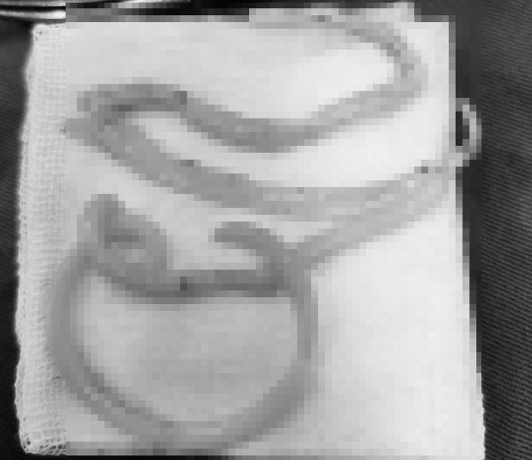 Bệnh nhân K.T.T (43 tuổi, ở huyện Bác Ái) bị thủng ruột non do giun đũa - Ảnh BVCC