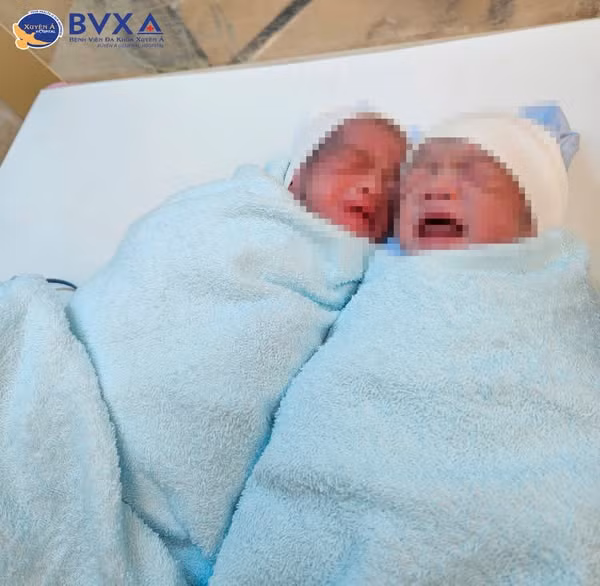 2 bé bị truyền máu song thai ra đời khỏe mạnh - Ảnh BVCC
