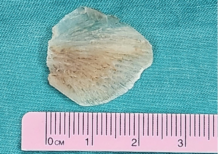 Dị vật xương cá kích thước 23x23mm sau khi được bác sĩ lấy ra - Ảnh BVCC