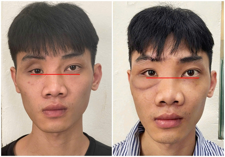 Tạo hình thành ổ mắt bằng công nghệ titan chữa mắt biến dạng sau tai nạn ảnh 6