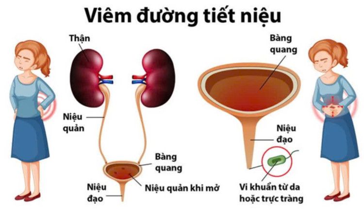 Nhiễm trùng tiết niệu tiền mãn kinh, hiểu để bảo vệ sức khỏe từ gốc - Ảnh BSCC