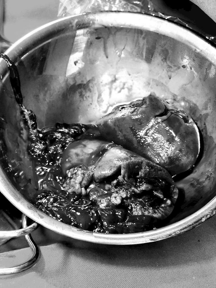 Báo động đỏ cứu bệnh nhân vỡ lách, đa chấn thương, tính mạng tính bằng phút ảnh 2