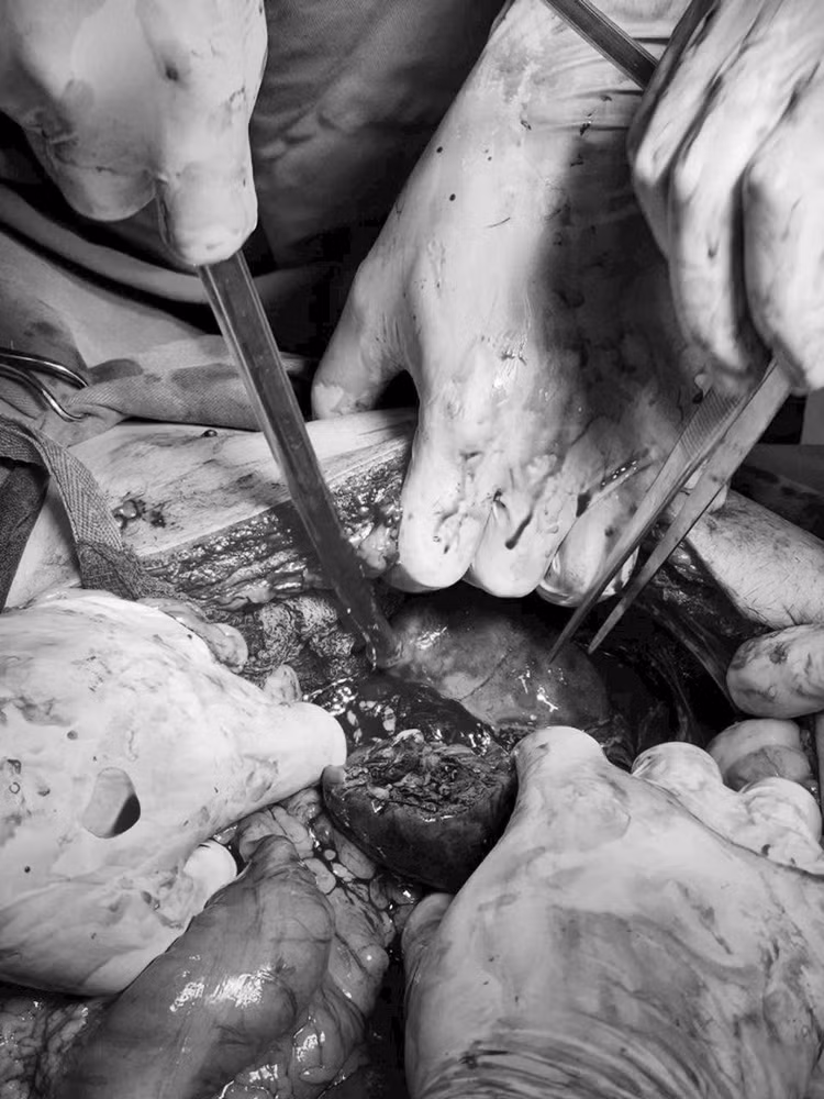 Báo động đỏ cứu bệnh nhân vỡ lách, đa chấn thương, tính mạng tính bằng phút ảnh 3