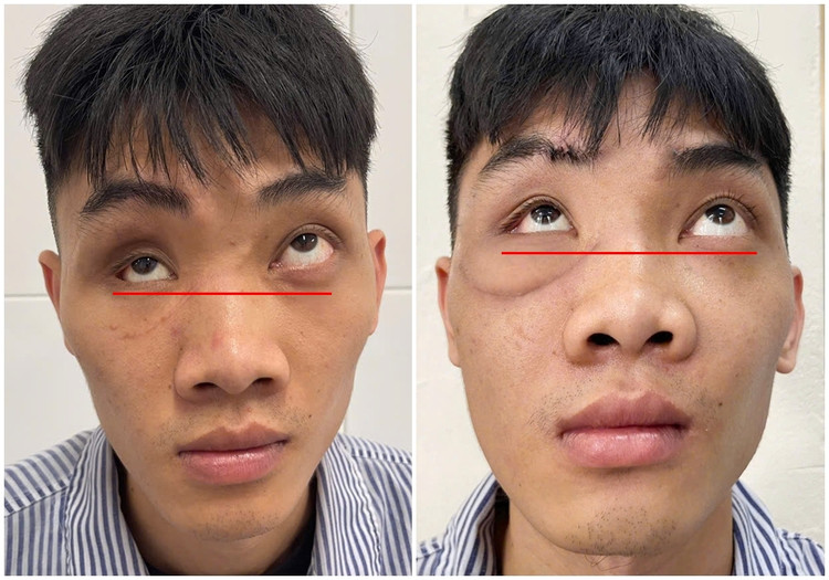 Tạo hình thành ổ mắt bằng công nghệ titan chữa mắt biến dạng sau tai nạn ảnh 5