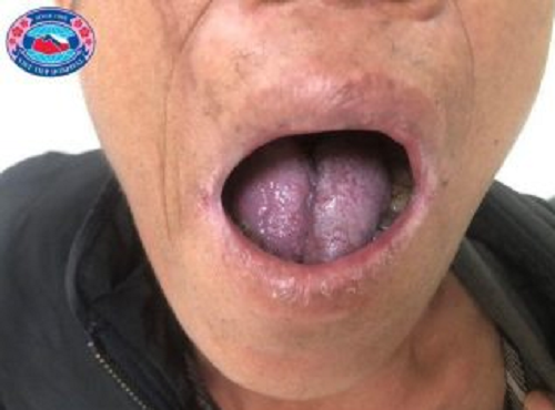 Hình ảnh người bệnh phục hồi hoàn toàn sau phẫu thuật - Ảnh: BVCC