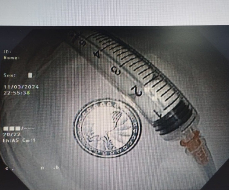 Đồng xu được lấy ra khỏi thực quản