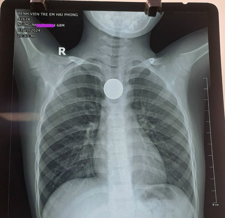 Đồng xu chơi game trong thực quản bệnh nhi