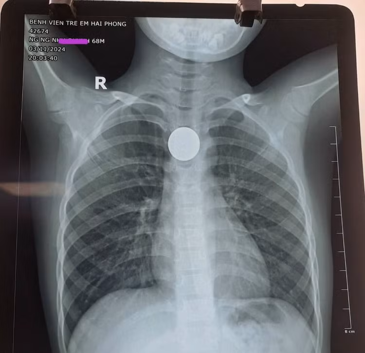 Đồng xu chơi game trong thực quản bệnh nhi