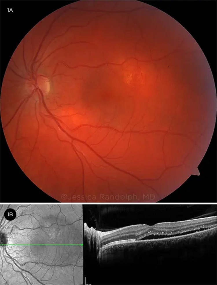 Ảnh đáy mắt của một mắt bị CSC cho thấy dịch dưới võng mạc vùng hoàng điểm trên lâm sàng và ảnh chụp với OCT.