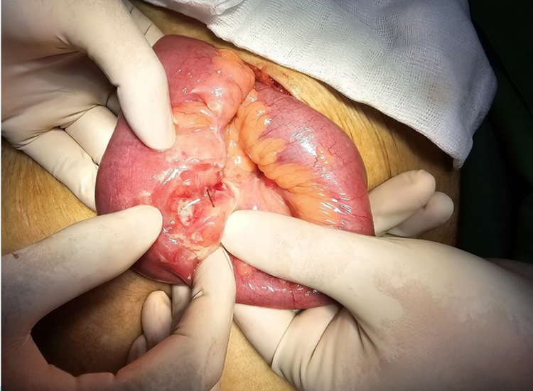 Hình ảnh xương cá đâm thủng ruột non.