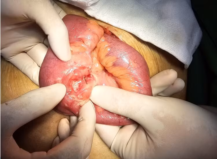 Hình ảnh xương cá đâm thủng ruột non.