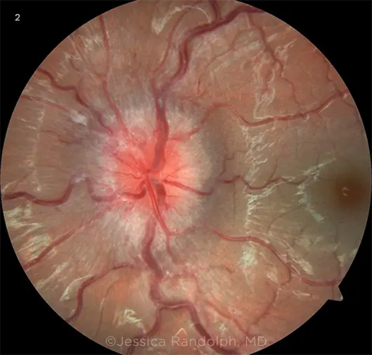 Tăng áp lực nội sọ vô căn: Ảnh chụp đáy mắt cho thấy dây thần kinh thị giác bị phù, che khuất bờ gai.