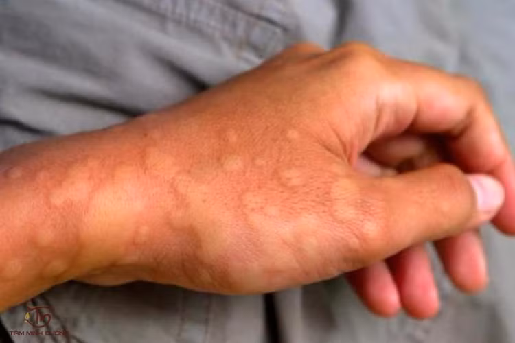 Nổi mày đay khi thời tiết giá lạnh