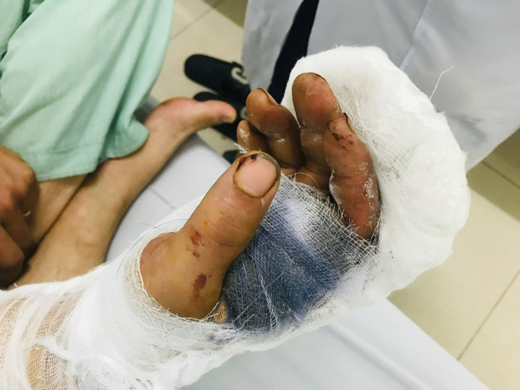 Bệnh nhân sau phẫu thuật vi phẫu bảo tồn ngón tay, bàn tay phục hồi nguyên hình dáng - Ảnh BVCC