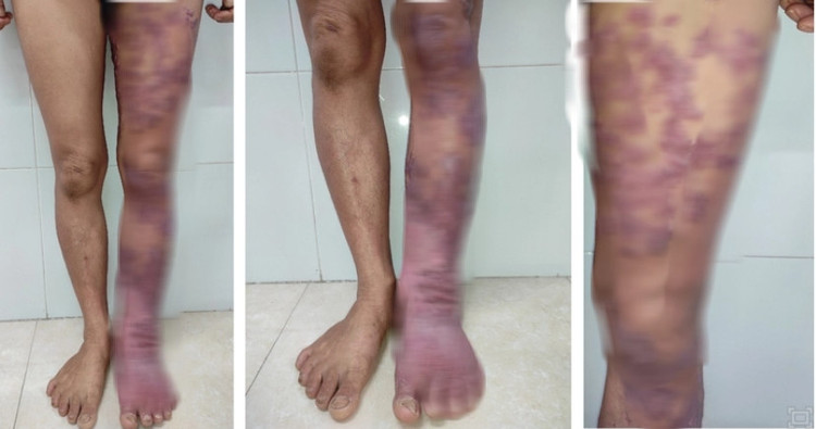 Hình 1: Tổn thương nấm Chromoblastomycosis gây biến dạng chân trái ở thời điểm mới nhập viện (Nguồn: Bệnh viện Da liễu trung ương)