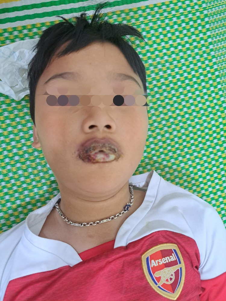 Tự dùng thuốc ho, sốt tại nhà trẻ 11 tuổi lở loét niêm mạc nặng