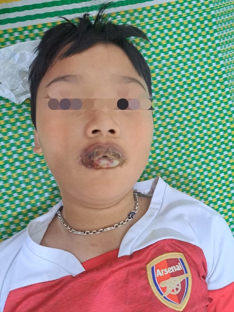 Tự dùng thuốc ho, sốt tại nhà trẻ 11 tuổi lở loét niêm mạc nặng