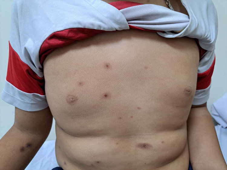 Phát ban trên da sau uống thuốc