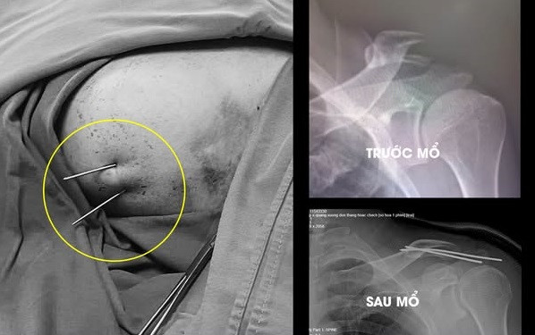 Phẫu thuật gãy xương trên màn hình C.Arm cho bệnh nhân - Ảnh BVCC