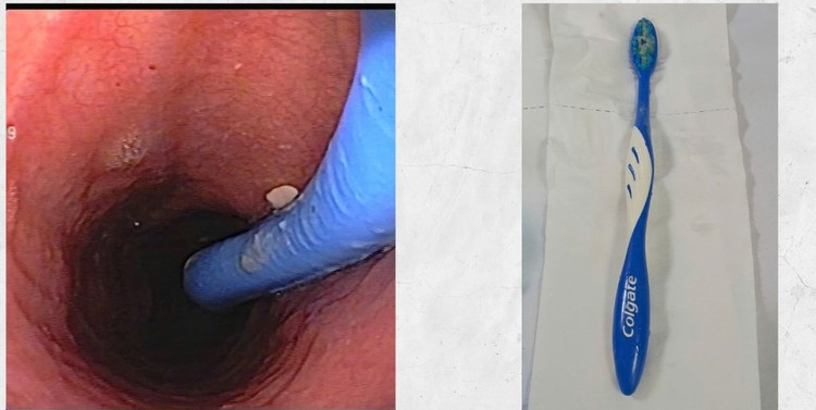 Chiếc bàn chải đánh răng trong thực quản bệnh nhân và sau khi được lấy ra - ảnh BVCC