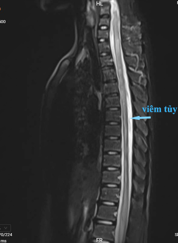 Hình ảnh phim chụp cộng hưởng từ cho thấy người bệnh bị viêm tủy từ cột sống C3 đến D7 - Ảnh BSCC