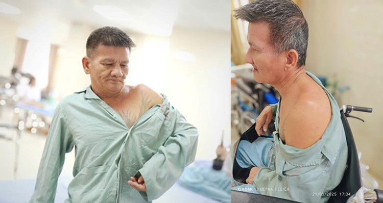 Người bệnh bị bán trật khớp vai - Ảnh BVCC