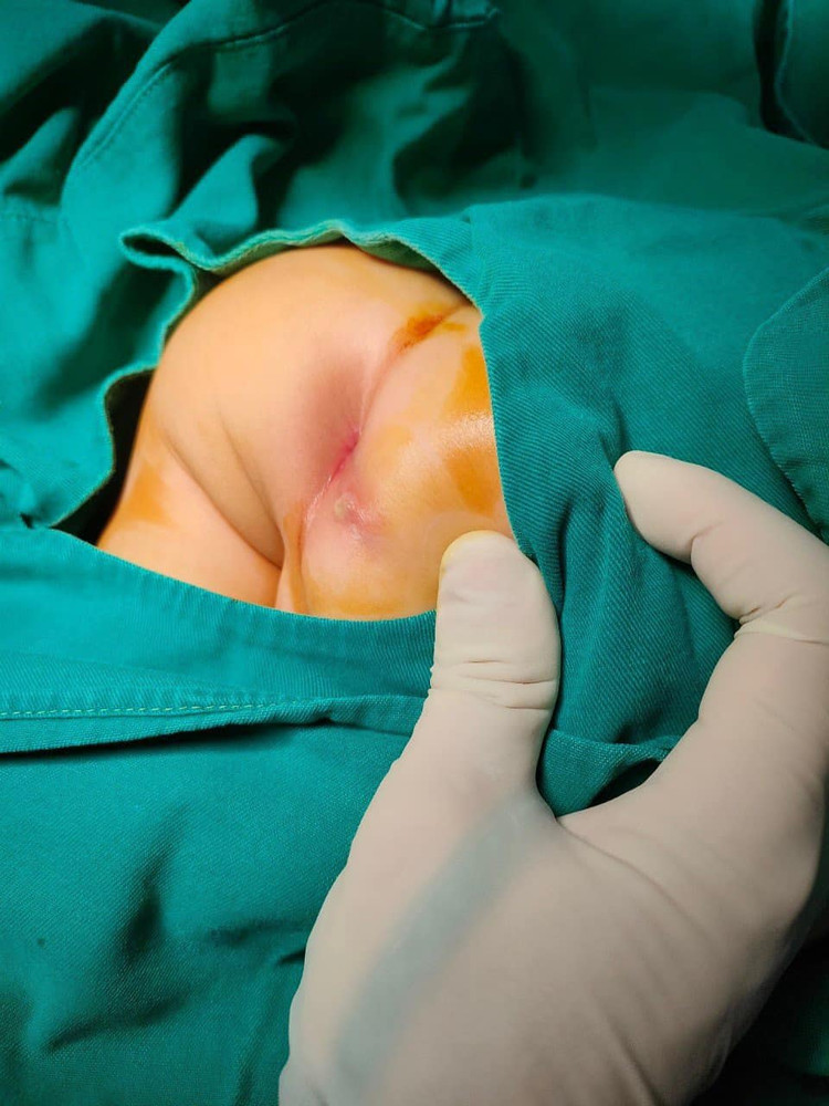 Trẻ 7 tháng tuổi bị áp xe rò hậu môn