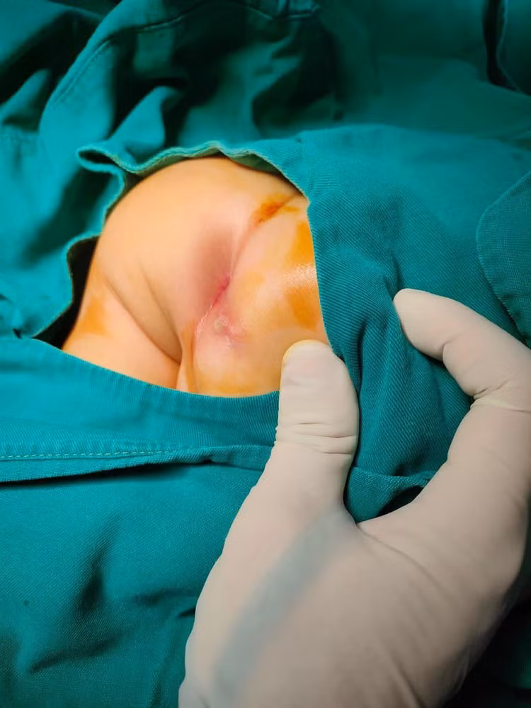 Trẻ 7 tháng tuổi bị áp xe rò hậu môn