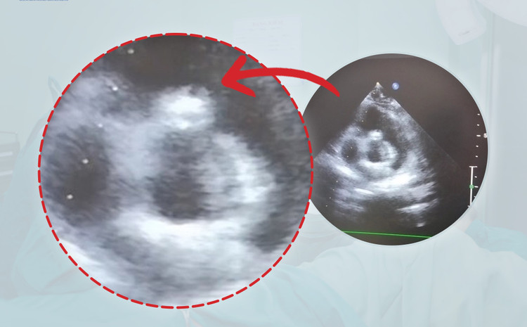 Bít dù điều trị tim bẩm sinh thông liên thất dưới hai đại động mạch ảnh 2