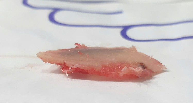 Bệnh nhân được phẫu thuật nội soi khoang màng phổi hoàn toàn, mảnh xương sườn gãy vụn được lấy ra - Ảnh BVCC