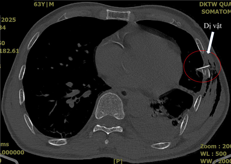 Hình ảnh chụp cắt lớp ngực của bệnh nhân V.Đ.Q. ghi nhận tràn khí, tràn máu màng phổi với một mảnh xương sườn đâm vào nhu mô phổi - Ảnh BVCC