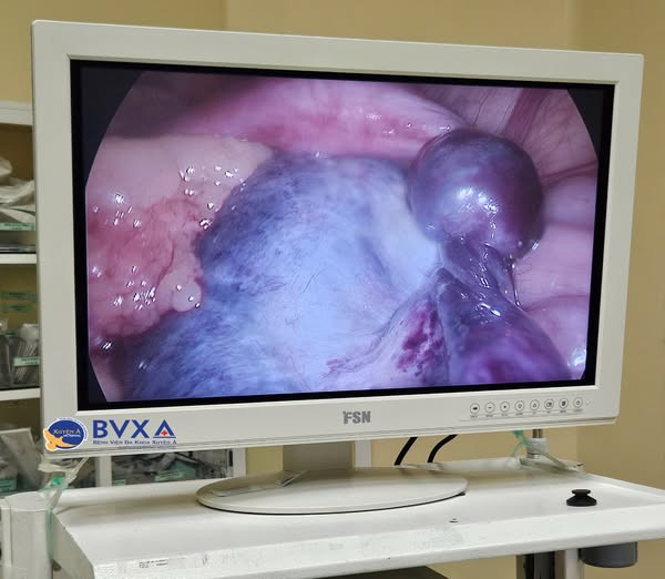 U buồng trứng kích thước lớn xoắn vặn - Ảnh BVCC