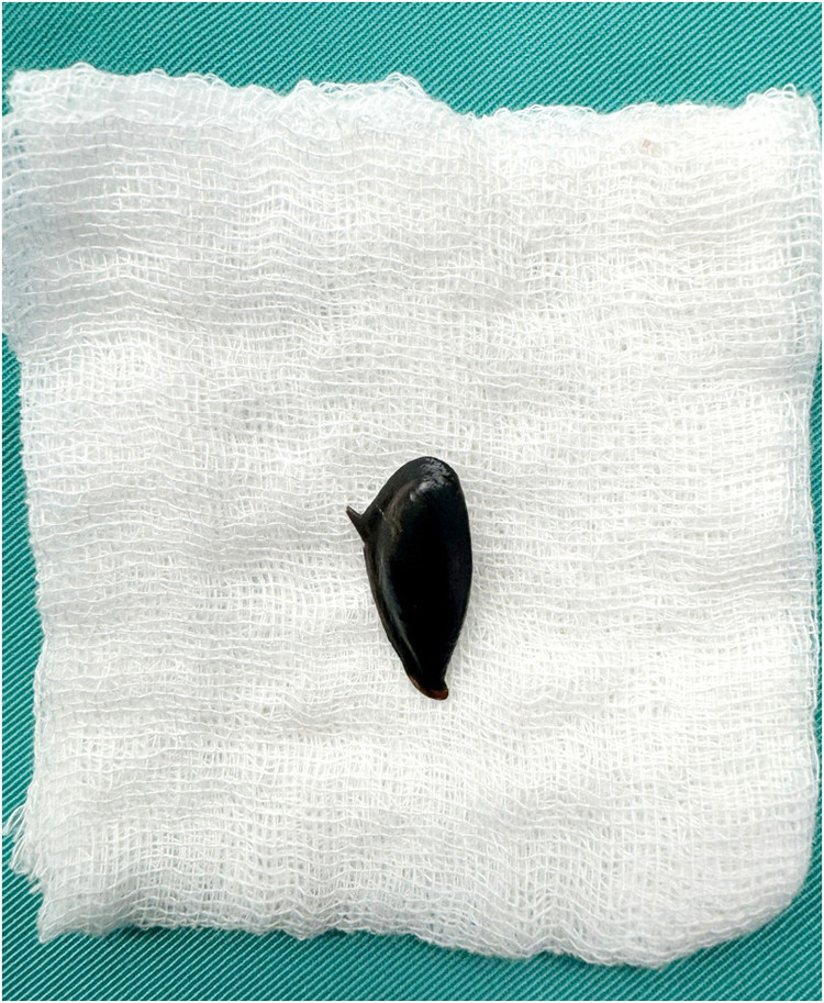 Hạt hồng xiêm được lấy ra - Ảnh BSCC