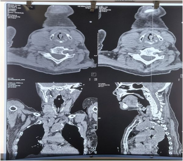 Hạt hồng xiêm trên phim chụp - Ảnh BVCC
