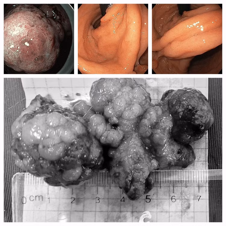 Cắt tách niêm mạc qua nội soi lấy polyp lớn dạ dày ung thư hóa - Ảnh BVCC