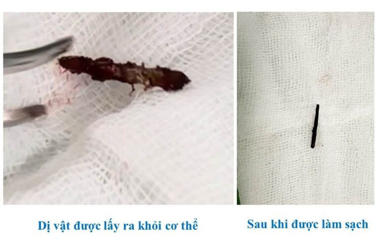 Chiếc đinh được lấy ra trong tình trạng rỉ sét