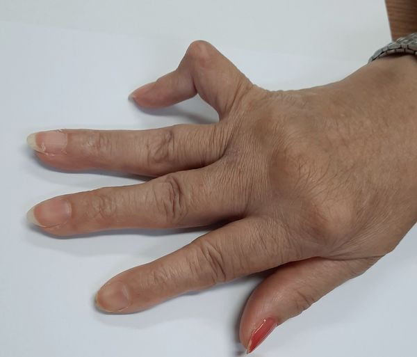 Biểu hiện của viêm khớp dạng thấp - ảnh BSCC