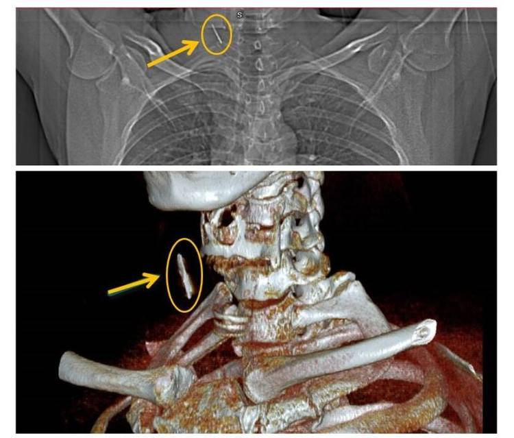 Kết quả cho thấy dị vật phần mềm vùng cổ ngang C6-C7 và Hình ảnh dị vật trên phim chụp CT cắt lớp vi tính có dựng hình