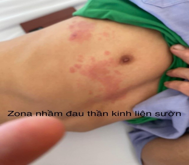Hình ảnh bệnh lý Zona nhầm lẫn với đau thần kinh tọa và đau thần kinh liên sườn