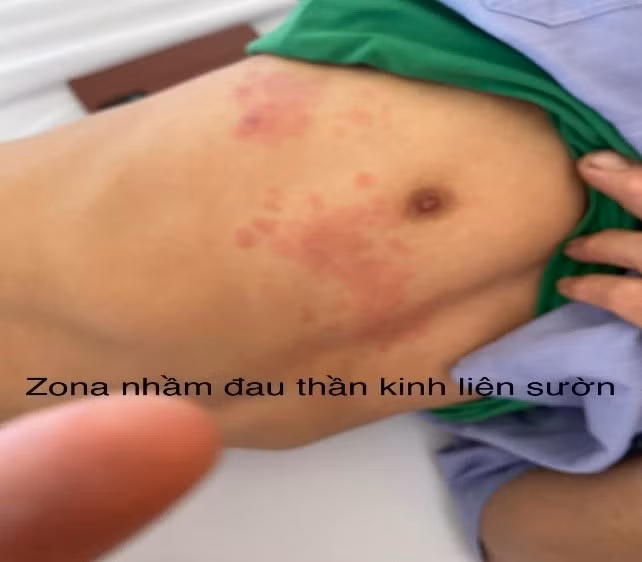 Hình ảnh bệnh lý Zona nhầm lẫn với đau thần kinh tọa và đau thần kinh liên sườn Hình ảnh bệnh lý Zona nhầm lẫn với đau thần kinh tọa và đau thần kinh liên sườn
