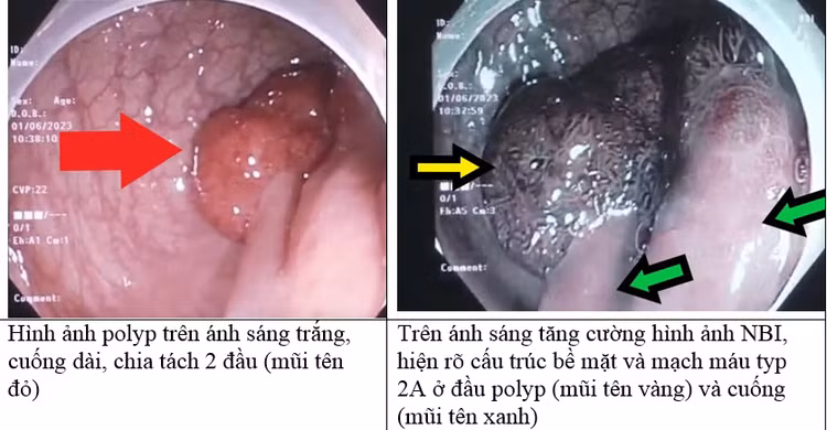 Hình ảnh polyp đại trực tràng đôi