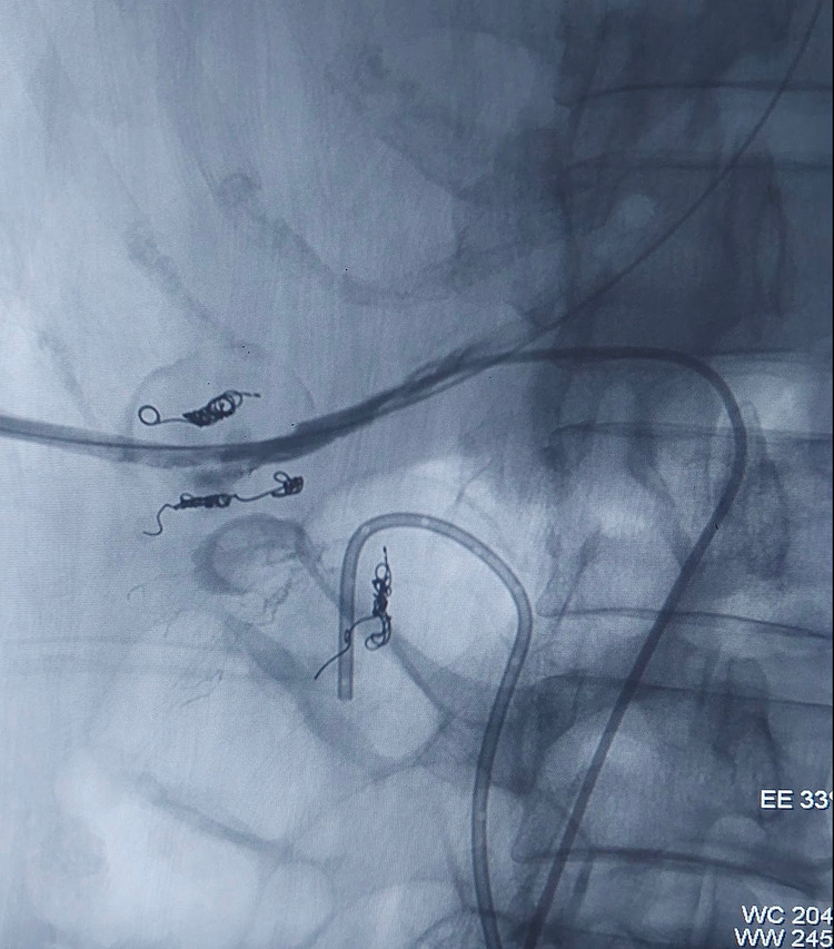 Hy hữu: Đặt dẫn lưu thận vào tĩnh mạch chủ bụng ảnh 3