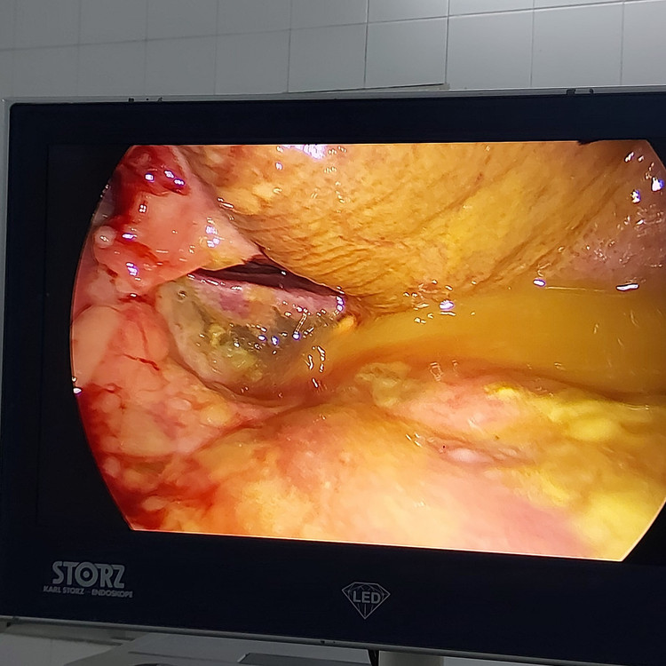 Lỗ thủng dạ dày trên nội soi