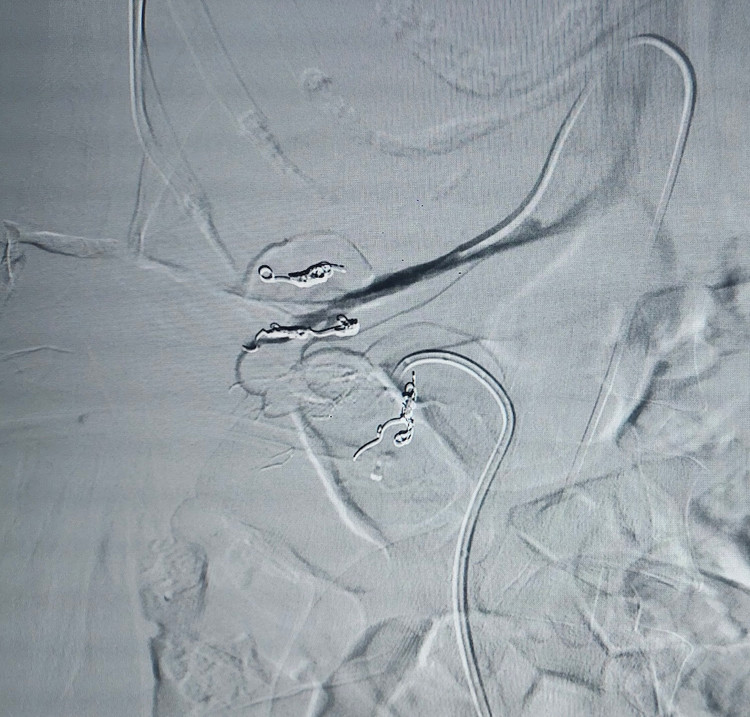 Hy hữu: Đặt dẫn lưu thận vào tĩnh mạch chủ bụng ảnh 4