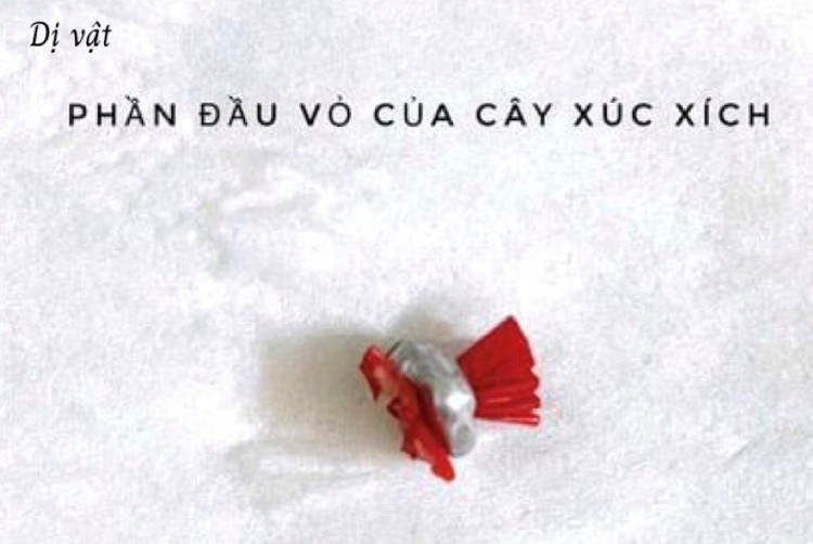 Dị vật được lấy ra thành công - Ảnh BVCC